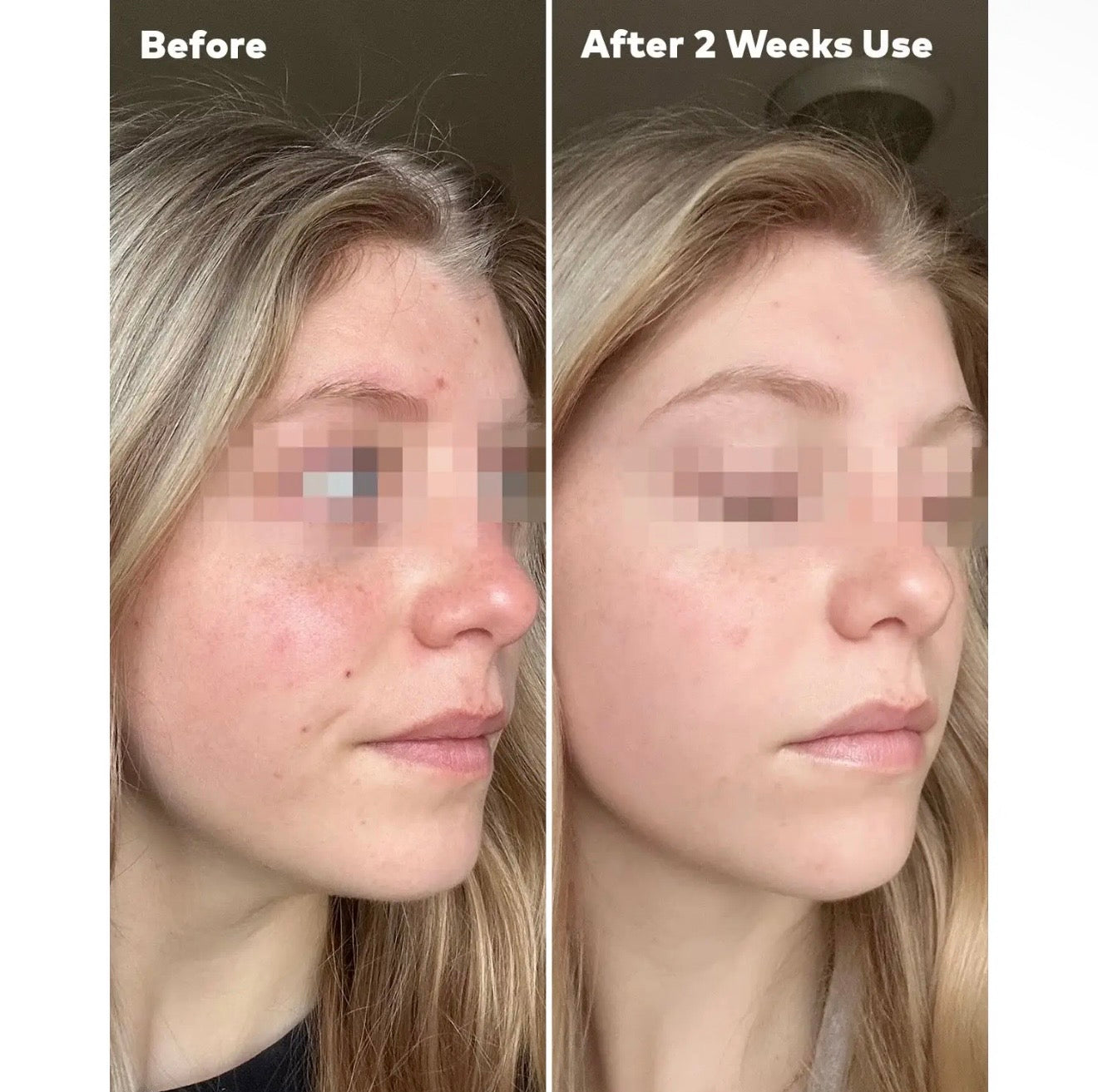 Silver Infused Mini Pro| Designed for Blemish-Prone Skin